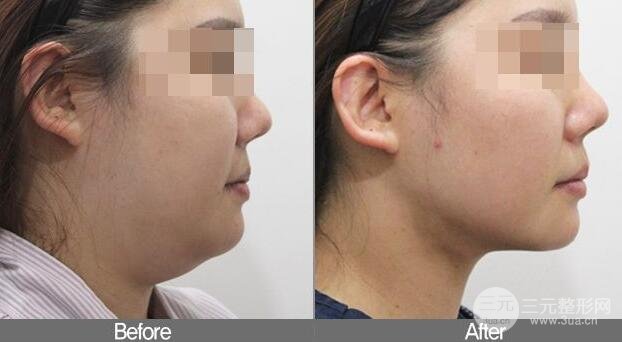 面部吸脂大概要多少錢？面部吸脂減肥價(jià)格表和前后果圖片