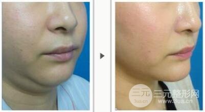 面部吸脂大概要多少錢？面部吸脂減肥價(jià)格表和前后果圖片