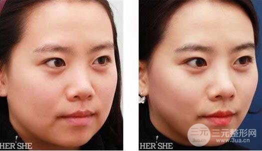 面部吸脂大概要多少錢？面部吸脂減肥價(jià)格表和前后果圖片