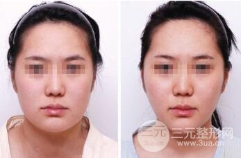 面部吸脂大概要多少錢？面部吸脂減肥價(jià)格表和前后果圖片