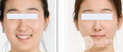 面部吸脂大概要多少錢？面部吸脂減肥價(jià)格表和前后果圖片