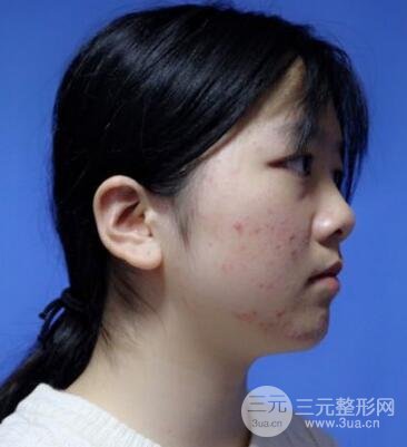 怎樣減掉雙下巴?雙下巴吸脂后個人經(jīng)歷 價格略貴但果好