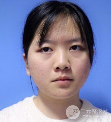 怎樣減掉雙下巴?雙下巴吸脂后個人經(jīng)歷 價格略貴但果好