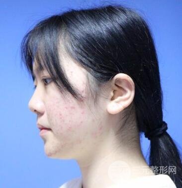 怎樣減掉雙下巴?雙下巴吸脂后個人經(jīng)歷 價格略貴但果好