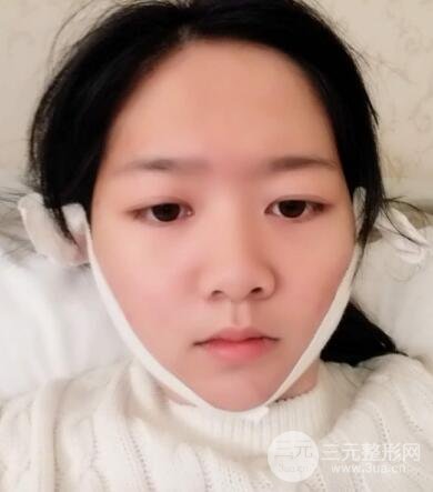 怎樣減掉雙下巴?雙下巴吸脂后個人經(jīng)歷 價格略貴但果好