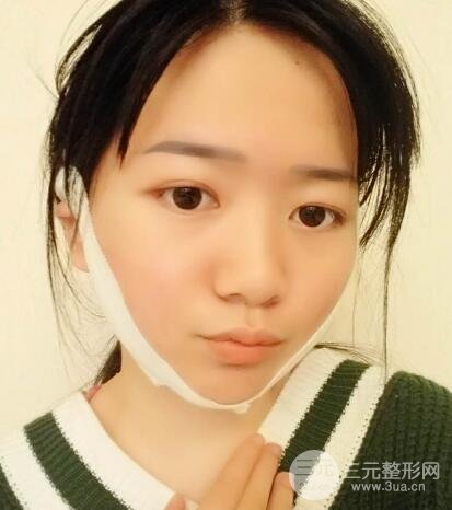 怎樣減掉雙下巴?雙下巴吸脂后個人經(jīng)歷 價格略貴但果好