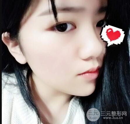 怎樣減掉雙下巴?雙下巴吸脂后個人經(jīng)歷 價格略貴但果好