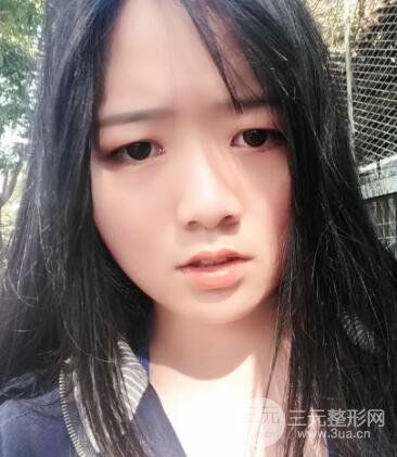 怎樣減掉雙下巴?雙下巴吸脂后個人經(jīng)歷 價格略貴但果好