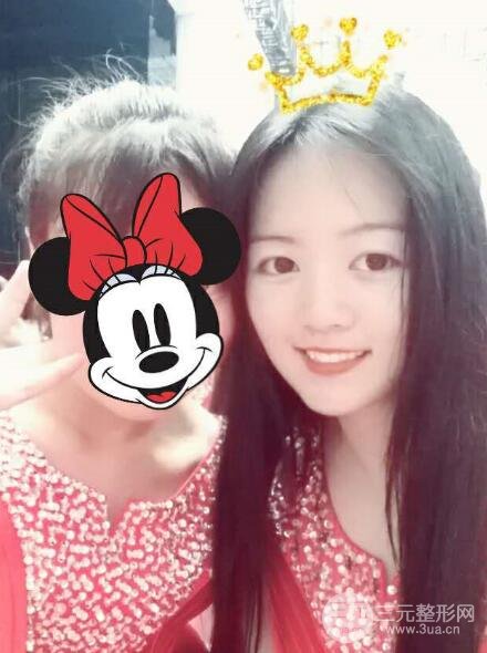 怎樣減掉雙下巴?雙下巴吸脂后個人經(jīng)歷 價格略貴但果好