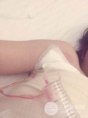 珠海萊茵門(mén)診部盧剛醫(yī)生假體隆胸真實(shí)案例，還有前后對(duì)比照片喲