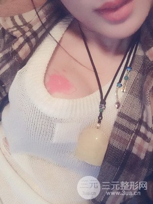 珠海萊茵門(mén)診部盧剛醫(yī)生假體隆胸真實(shí)案例，還有前后對(duì)比照片喲