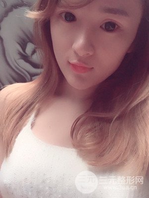 珠海萊茵門(mén)診部盧剛醫(yī)生假體隆胸真實(shí)案例，還有前后對(duì)比照片喲