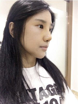 珠海萊茵門診部馬中衛(wèi)隆鼻整形案例分享，并附上前后對(duì)比照片~