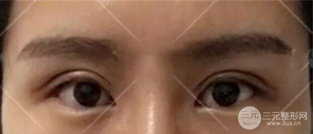 割歐式雙眼皮價(jià)格和案例