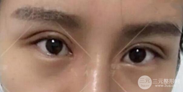 割歐式雙眼皮價(jià)格和案例
