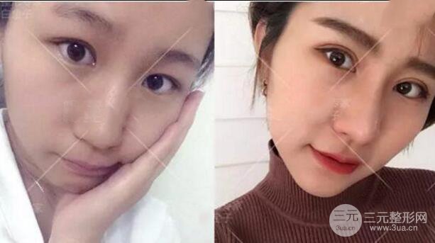 割歐式雙眼皮價(jià)格和案例