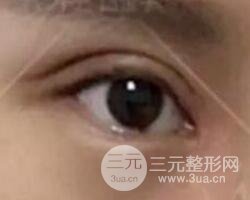 割歐式雙眼皮價格和案例