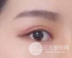 割歐式雙眼皮價格和案例