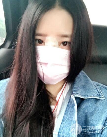 隆鼻整形包括假體隆鼻+耳軟骨墊鼻尖+鼻小柱延長(zhǎng)