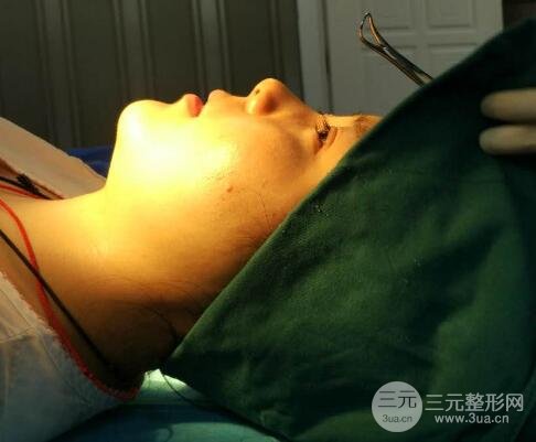 隆鼻整形包括假體隆鼻+耳軟骨墊鼻尖+鼻小柱延長(zhǎng)