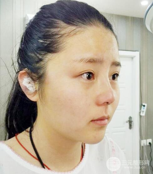 隆鼻整形包括假體隆鼻+耳軟骨墊鼻尖+鼻小柱延長(zhǎng)