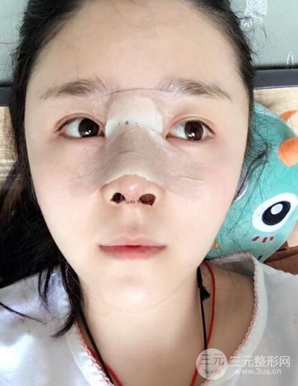 隆鼻整形包括假體隆鼻+耳軟骨墊鼻尖+鼻小柱延長(zhǎng)