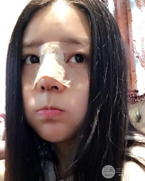 隆鼻整形包括假體隆鼻+耳軟骨墊鼻尖+鼻小柱延長(zhǎng)