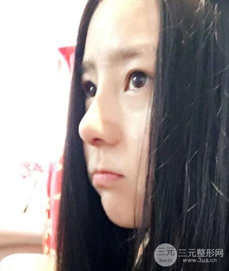 隆鼻整形包括假體隆鼻+耳軟骨墊鼻尖+鼻小柱延長(zhǎng)