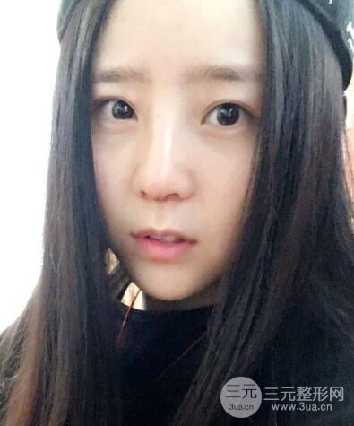 隆鼻整形包括假體隆鼻+耳軟骨墊鼻尖+鼻小柱延長(zhǎng)