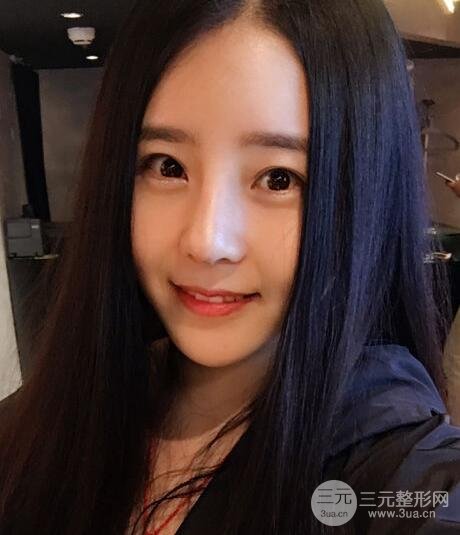 隆鼻整形包括假體隆鼻+耳軟骨墊鼻尖+鼻小柱延長(zhǎng)