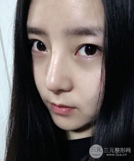 隆鼻整形包括假體隆鼻+耳軟骨墊鼻尖+鼻小柱延長(zhǎng)