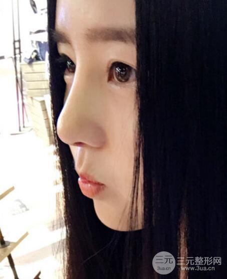 隆鼻整形包括假體隆鼻+耳軟骨墊鼻尖+鼻小柱延長(zhǎng)