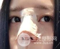 隆鼻整形包括假體隆鼻+耳軟骨墊鼻尖+鼻小柱延長