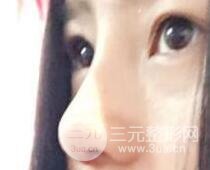 隆鼻整形包括假體隆鼻+耳軟骨墊鼻尖+鼻小柱延長