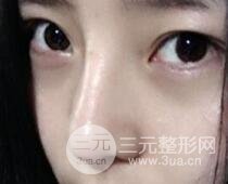 隆鼻整形包括假體隆鼻+耳軟骨墊鼻尖+鼻小柱延長