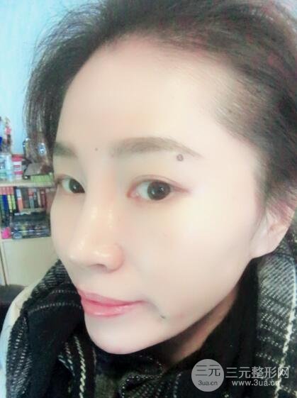 面b提升術(shù)多少錢?價(jià)格和案例分享