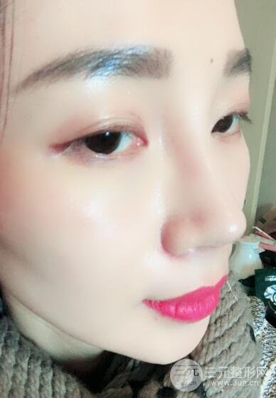 面b提升術(shù)多少錢?價(jià)格和案例分享