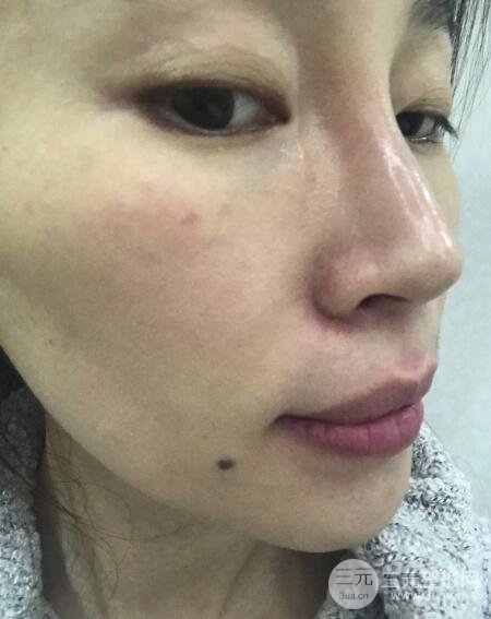 面b提升術(shù)多少錢?價(jià)格和案例分享