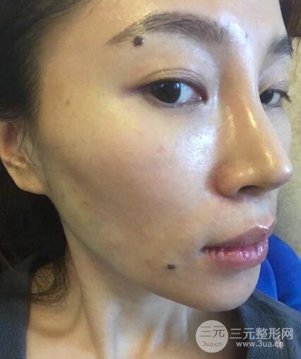 面b提升術(shù)多少錢?價(jià)格和案例分享