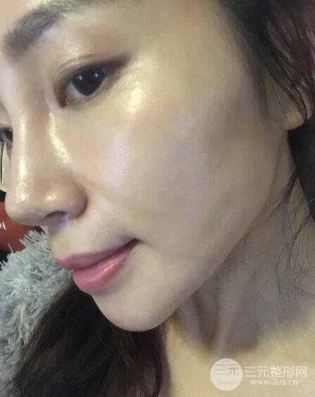 面b提升術(shù)多少錢?價(jià)格和案例分享