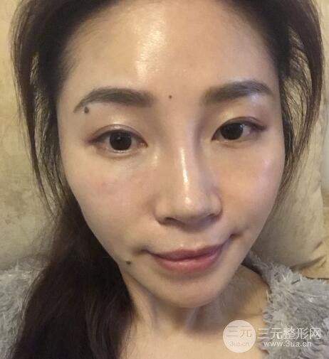 面b提升術(shù)多少錢?價(jià)格和案例分享