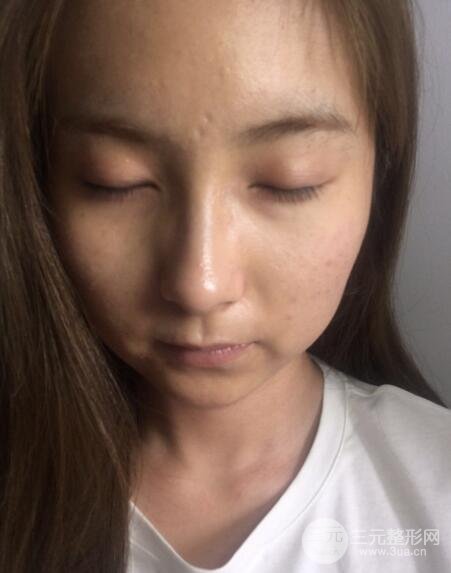 注射水光補水價格和案例圖片