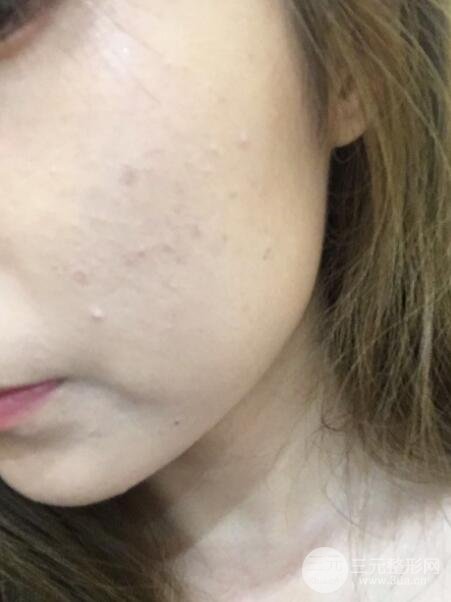 注射水光補水價格和案例圖片