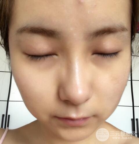 注射水光補水價格和案例圖片