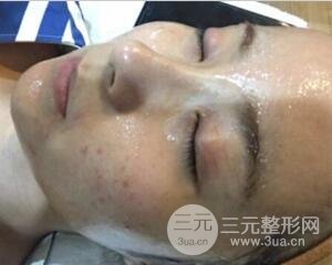 注射水光補(bǔ)水價(jià)格和案例圖片