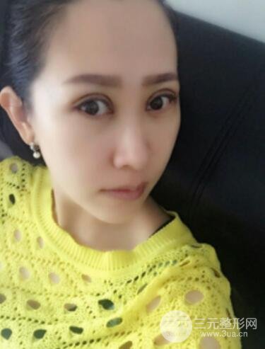 雙眼皮修復(fù)術(shù)價(jià)錢和案例圖