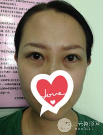 雙眼皮修復(fù)術(shù)價(jià)錢和案例圖