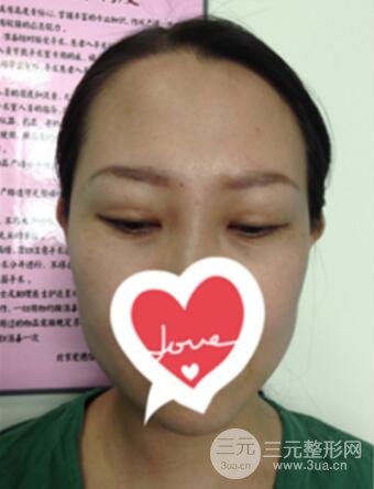 雙眼皮修復(fù)術(shù)價(jià)錢和案例圖