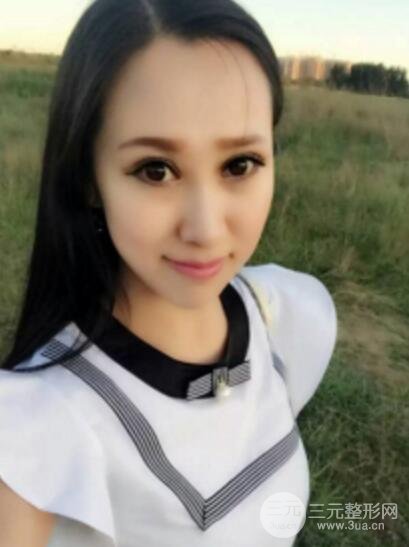 雙眼皮修復(fù)術(shù)價(jià)錢和案例圖