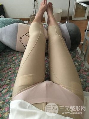 珠海萊茵門(mén)診部盧剛給我做的大腿抽脂手術(shù)，前后對(duì)比圖分享